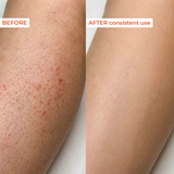 Before and after comparison of skin treatment on a leg.