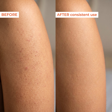 Before and after comparison of a person's leg with visible improvement in skin texture and clarity.