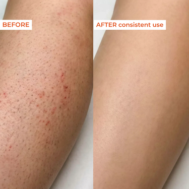 Before and after comparison of skin treatment on a leg.
